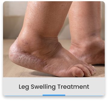 Vein Clinic Leg Swelling Treatment